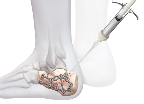 Arthrex - BoneSync Fast-Setting Drillable Calcium Phosphate Cement